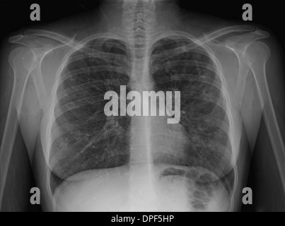 X-ray de poitrine montrant la fibrose kystique Banque D'Images