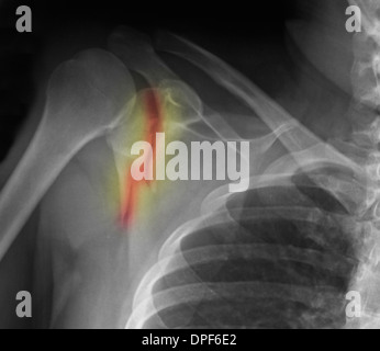 X-ray montrant de fracture de l'omoplate Banque D'Images