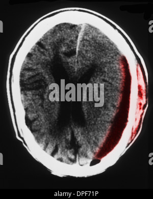 CT scan de cerveau montrant hématome sous Banque D'Images