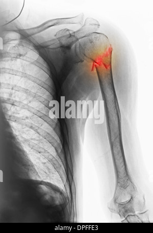 X-ray montrant la rupture de l'humérus Banque D'Images