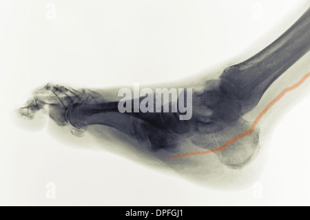 X-ray de pied diabétique de montrant l'artère calcifiée Banque D'Images