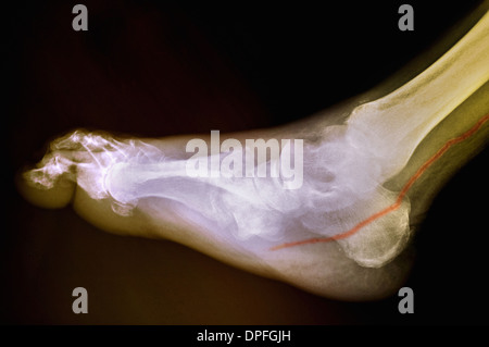 X-ray de pied diabétique de montrant l'artère calcifiée Banque D'Images