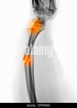 Radiographie d'une fracture de l'avant-bras radius Banque D'Images