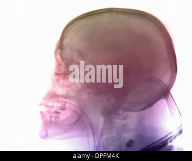 Rayons x du crâne de l'homme dans un accident de moto Banque D'Images