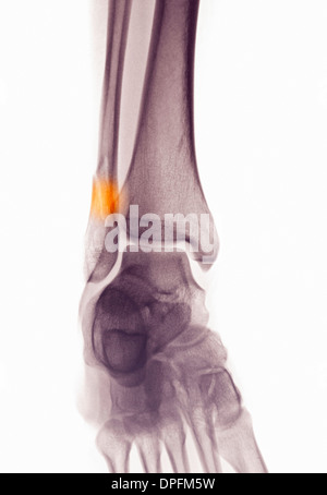 X ray la cheville Fracture du p ron distal montrant Photo Stock