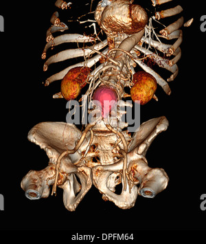 CT scan image montrant un anévrisme de l'aorte abdominale Banque D'Images