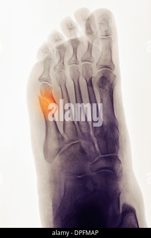 X-ray de pied montrant un cinquième Fracture métatarsienne Banque D'Images