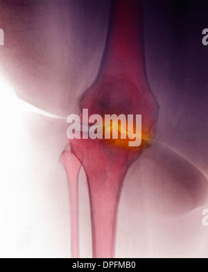 X-ray de genou montrant l'arthrite dégénérative Banque D'Images