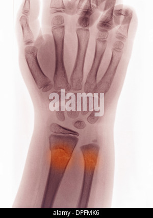 X-ray de fracture du poignet avec boucle Banque D'Images