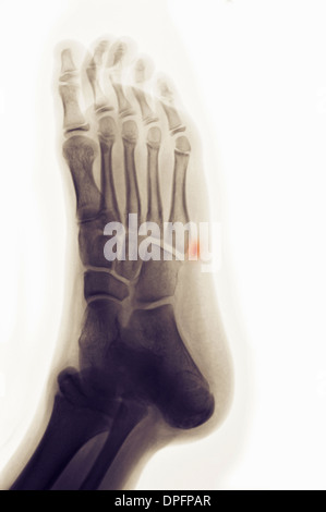 X-ray de pied montrant fracture-avulsion Banque D'Images