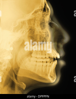 X-ray de la tête de profil Banque D'Images