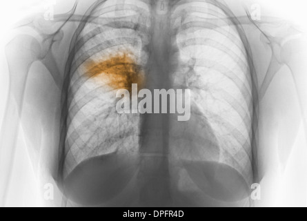 X-ray de poitrine montrant la pneumonie Banque D'Images