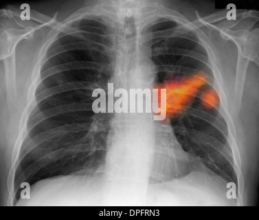 Radiographie des poumons d'un fumeur montrant le cancer du poumon Banque D'Images