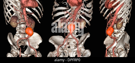 Les images CT scan d'un anévrisme de l'aorte abdominale Banque D'Images