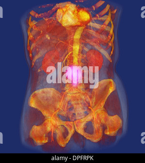 CT scan image montrant un anévrisme de l'aorte abdominale Banque D'Images