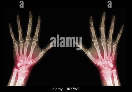 Les radiographies des mains d'un homme adulte avec des dommages visibles Banque D'Images