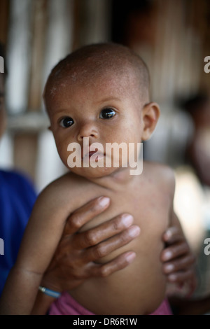 Portrait de bébé avec irritation de la peau, d'une famille vivant dans la pauvreté. Kupang, Timor oriental, Indonésie. Nov 2005 Banque D'Images