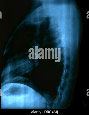 X Ray Image de la poitrine en bonne santé Banque D'Images