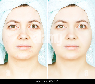 Avant et après la peau femme portant des cicatrices Banque D'Images