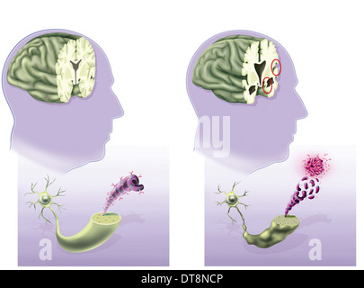 La maladie d'Alzheimer, dessin Banque D'Images