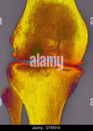 L'ARTHROSE DU GENOU, X-RAY Banque D'Images