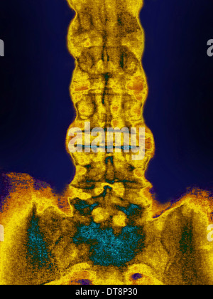 La spondylarthrite ankylosante, X-RAY Banque D'Images