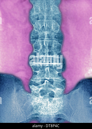 La spondylarthrite ankylosante, X-RAY Banque D'Images