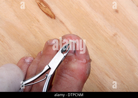 Chirurgie sur un ongle d'orteil cassé un homme Banque D'Images