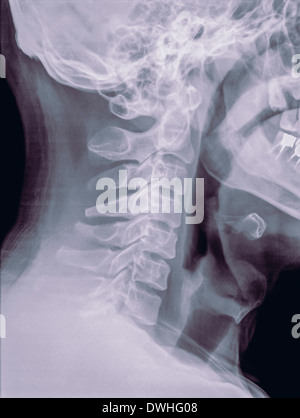 Rachis cervical radiographie d'un patient de 40 ans homme Vue de côté Banque D'Images