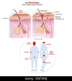 Le psoriasis, l'encombrement Banque D'Images