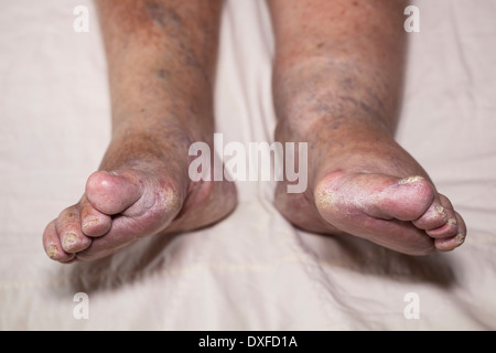 Détail de mauvais senior female un gonflement des jambes avec les orteils et les ongles endommagés. Banque D'Images