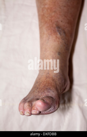 Détail de la mauvaise jambe enflée féminine senior avec les orteils et les ongles endommagés. Banque D'Images
