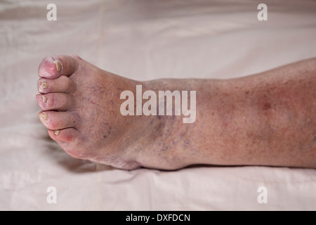 Détail de la mauvaise jambe enflée féminine senior avec les orteils et les ongles endommagés. Banque D'Images