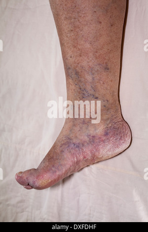 Détail de la mauvaise jambe enflée féminine senior avec les orteils et les ongles endommagés. Banque D'Images