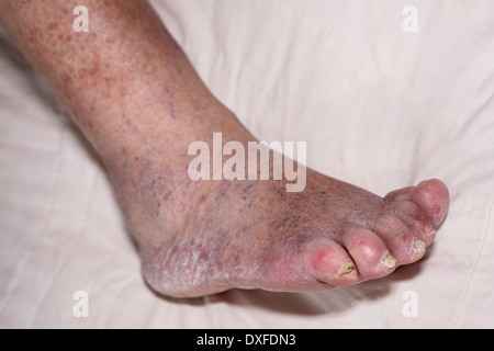 Détail de la mauvaise jambe enflée féminine senior avec les orteils et les ongles endommagés. Banque D'Images