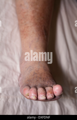 Détail de la mauvaise jambe enflée féminine senior avec les orteils et les ongles endommagés. Banque D'Images