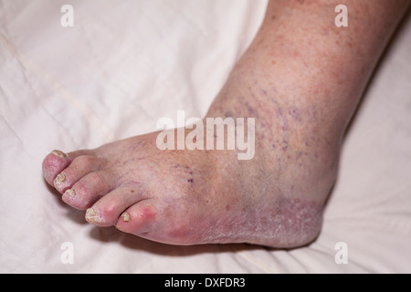 Détail de la mauvaise jambe enflée féminine senior avec les orteils et les ongles endommagés. Banque D'Images