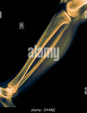 X-ray de la jambe inférieure de 50 ans homme avec fracture tibia vue avant Banque D'Images