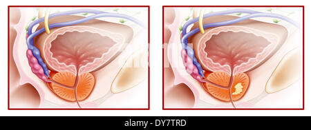 Le cancer de la prostate, dessin Banque D'Images