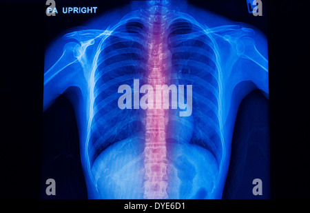 Radiographie de la colonne vertébrale humaine montrent la douleur backl Banque D'Images