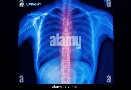 Radiographie de la colonne vertébrale humaine montrent les maux de dos Banque D'Images