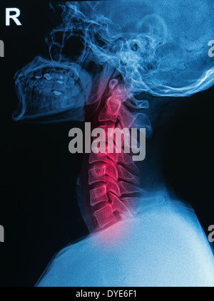 Les rayons X du crâne et de la colonne vertébrale cervicale ) ( VOIR UNE BLESSURE cervicale Banque D'Images