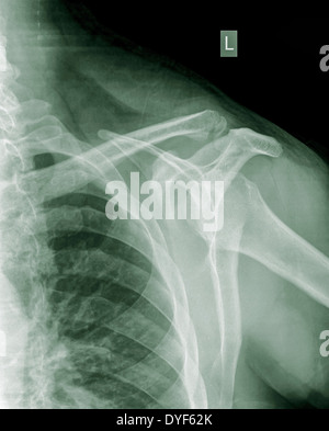 X-ray de l'épaule d'un homme de 40 ans avec une fracture de la clavicule vue avant Banque D'Images