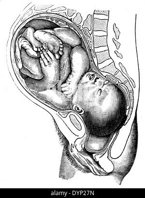 Position du fœtus dans l'utérus, illustration de l'Encyclopédie Soviétique, 1927 Banque D'Images