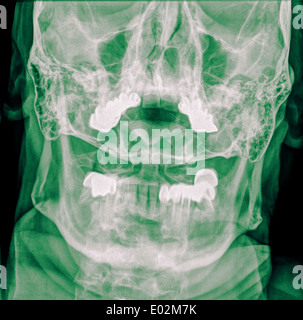 Colonne cervicale x-ray avec une fracture de la tanière. Un patient de sexe masculin âgé de 50 ans Vue avant Banque D'Images