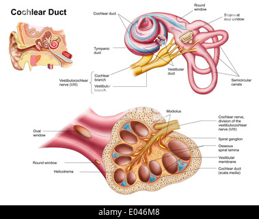 Anatomie de l'implant cochléaire dans le conduit de l'oreille humaine. Banque D'Images