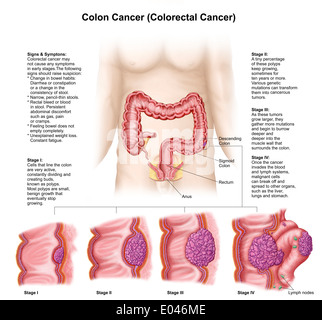 Illustration médicale décrivant les différents stades du cancer du côlon. Banque D'Images