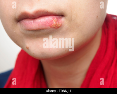 Jeune femme avec de l'herpès simplex sur la lèvre inférieure Banque D'Images