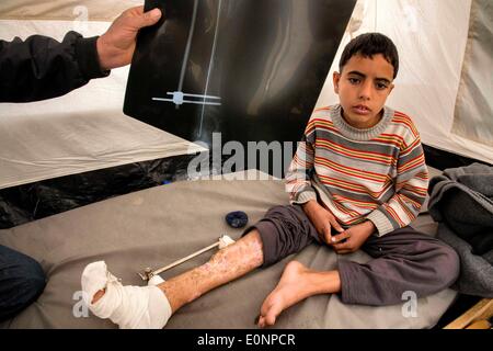 Le Camp de Zaatari, Al Mafraq, Jordanie. Jan 31, 2014. Les réfugiés de Zaatari - IBRAHIM SIRHAN a brisé sa jambe dans un bombardement à Deraa, en Syrie. Médecins syriens ont été en mesure de le réparer avec les tringles de l'acier et des vis. Dans le désert jordanien, à 10 kilomètres de la frontière syrienne se trouve un camp de réfugiés de Zaatari appelé. C'est le foyer de plus de 110 000 personnes déplacées qui ont fui la guerre en Syrie depuis juillet 2012. La plupart de ces réfugiés sont originaires de la région sud de Deraa où les combats ont été parmi les pires vu dans la guerre civile en Syrie qui a traîné pendant plus de trois ans. L'Armée syrienne libre Banque D'Images