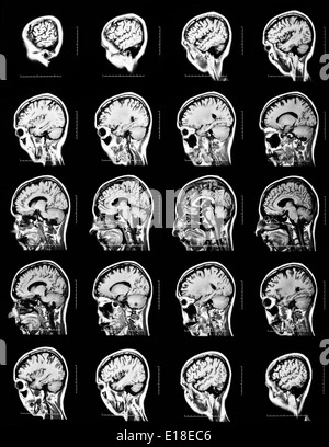 Séquence des sections verticales d'un cerveau humain - IRM Banque D'Images